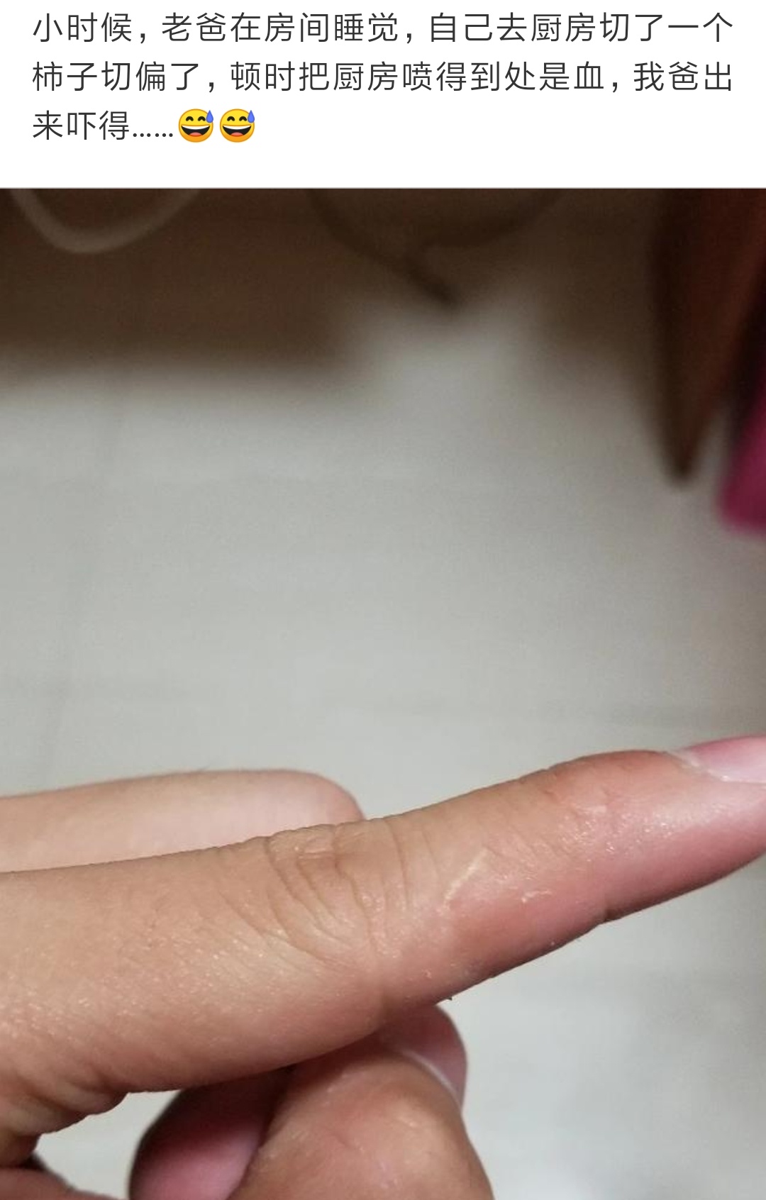 左手食指有疤痕代表什么意思（左手无名指有疤痕代表什么）