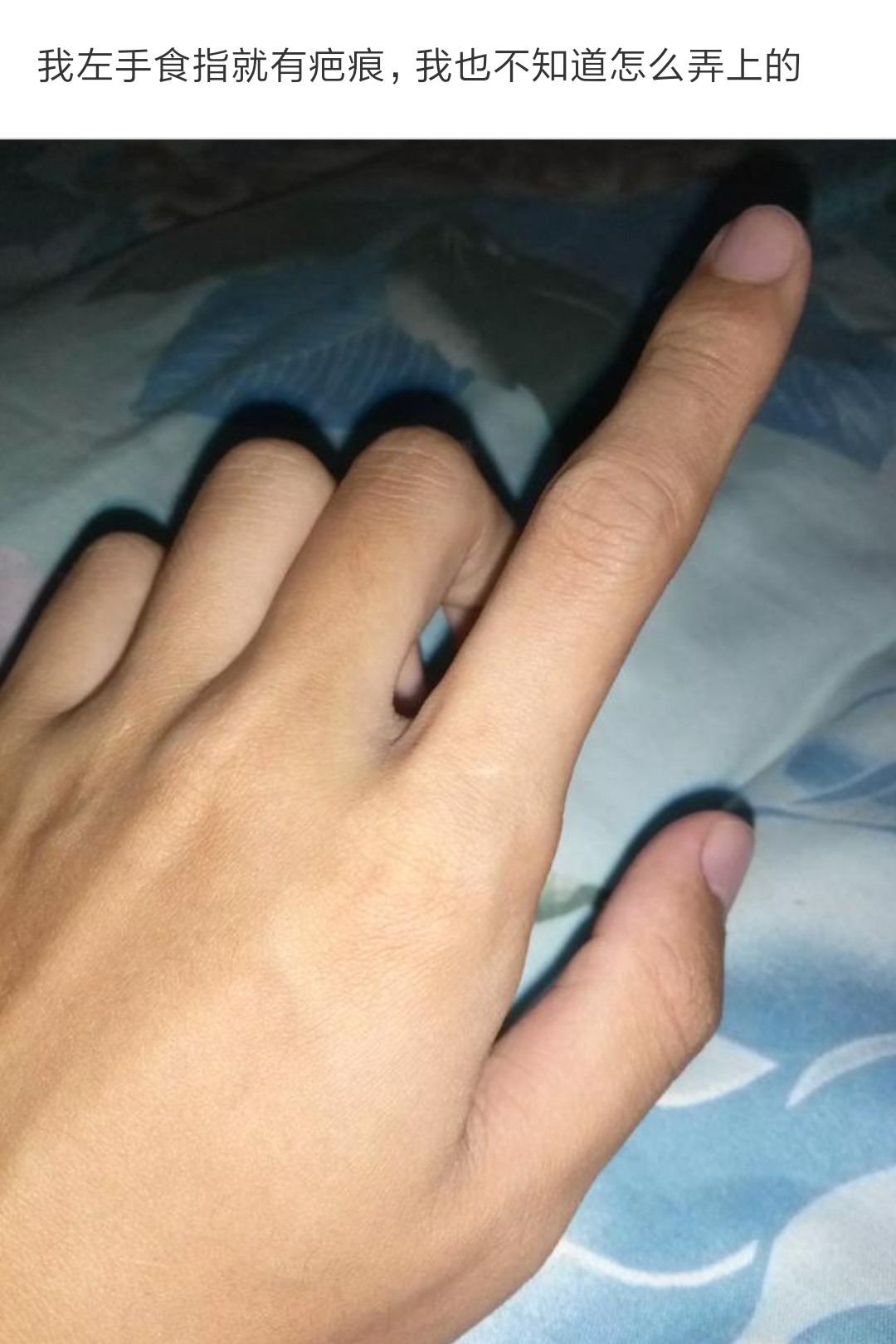 左手食指有疤痕代表什么意思（左手无名指有疤痕代表什么）